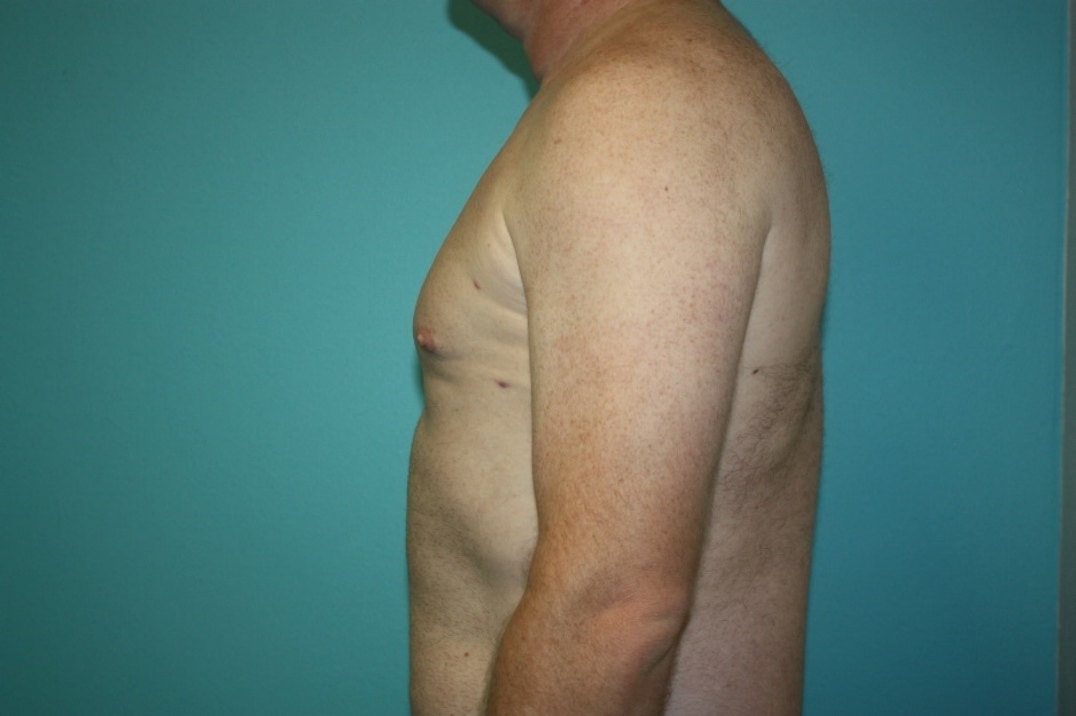 gynecomastia-h-3a After