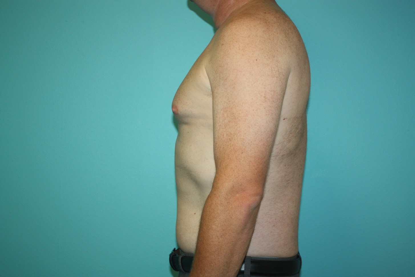 gynecomastia-h-3b Before