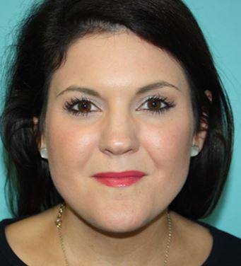 neck-lipo-pmf-1a After