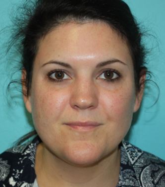 neck-lipo-pmf-1b Before