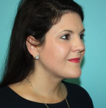 neck-lipo-pmf-2a After