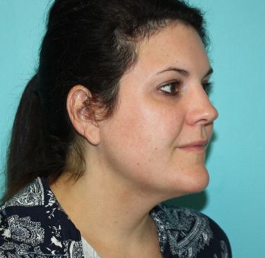 neck-lipo-pmf-2b Before