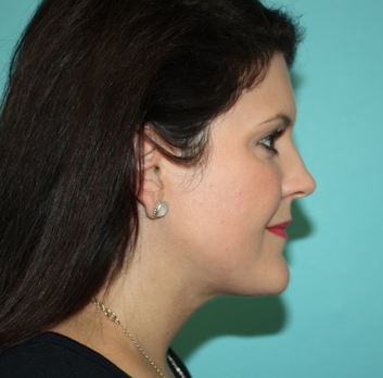 neck-lipo-pmf-3a After