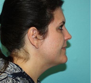 neck-lipo-pmf-3b Before