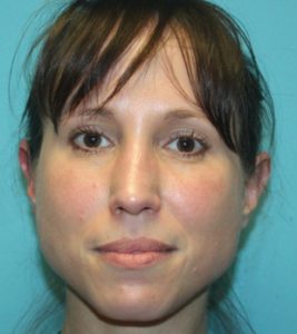 rhinoplasty-1-1a After