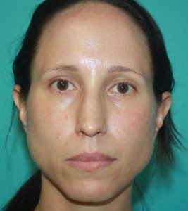 rhinoplasty-1-1b Before