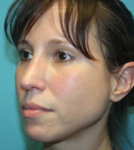 rhinoplasty-1-2a After