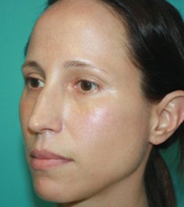 rhinoplasty-1-2b Before