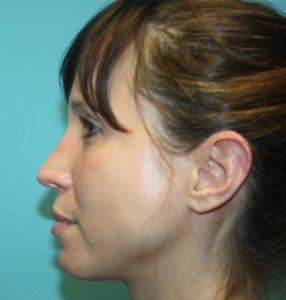 rhinoplasty-1-3a After