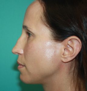 rhinoplasty-1-3b Before