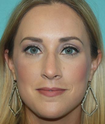 rhinoplasty-h-1a After