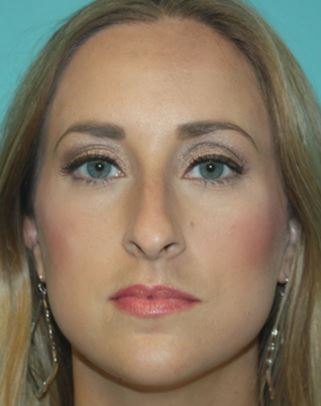 rhinoplasty-h-1b Before