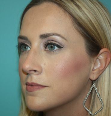 rhinoplasty-h-2a After