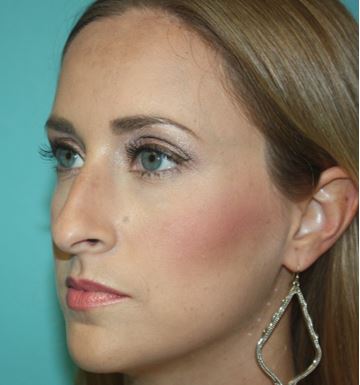 rhinoplasty-h-2b Before