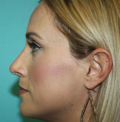 rhinoplasty-h-3a After