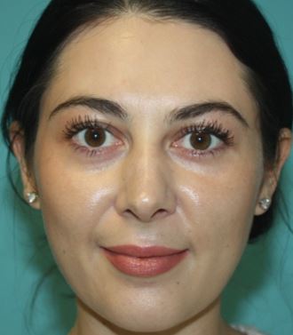 rhinoplasty-j-1a After