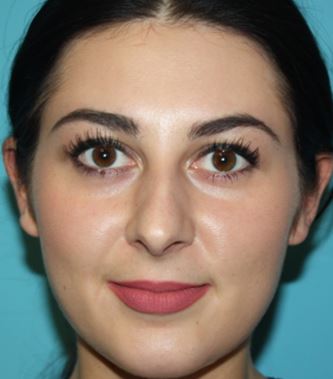 rhinoplasty-j-1b Before