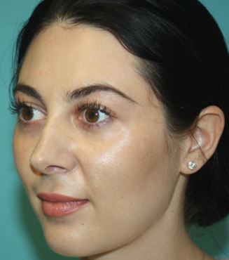 rhinoplasty-j-2a After