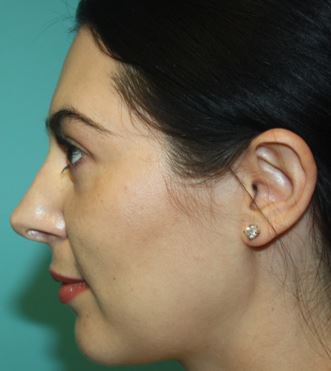 rhinoplasty-j-3a After