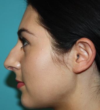 rhinoplasty-j-3b Before