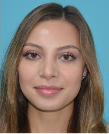 rhinoplasty-lskd-1a After
