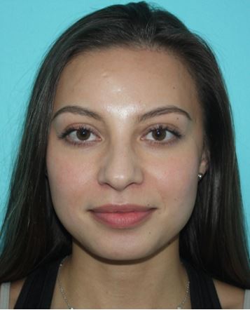 rhinoplasty-lskd-1b Before