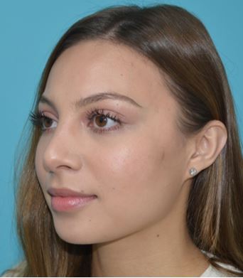 rhinoplasty-lskd-2a After