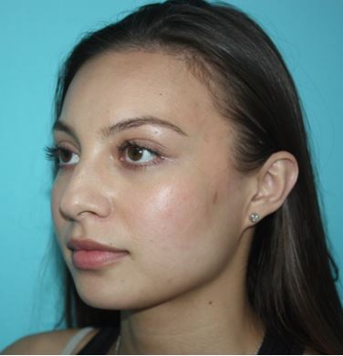 rhinoplasty-lskd-2b Before