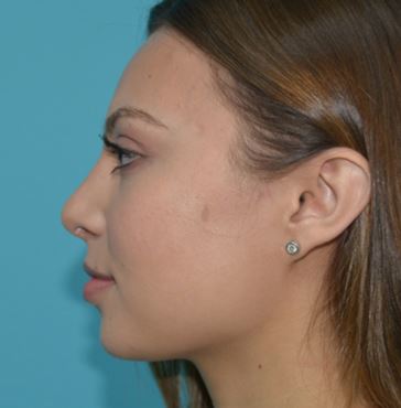rhinoplasty-lskd-3a After
