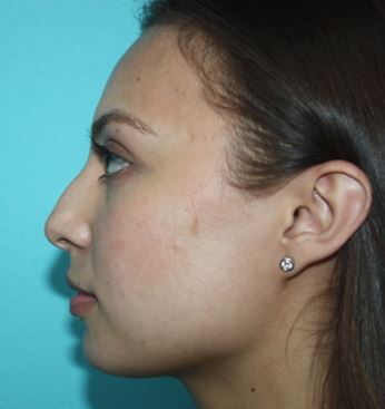 rhinoplasty-lskd-3b Before