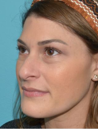 rhinoplasty-ogo-2b Before