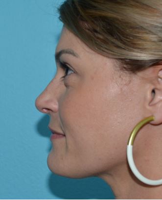 rhinoplasty-ogo-3a After