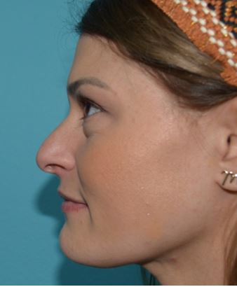rhinoplasty-ogo-3b Before