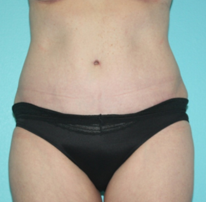 tummy-tuck-2-1a After