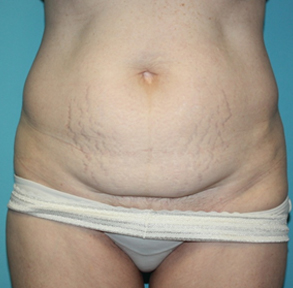 tummy-tuck-2-1b Before