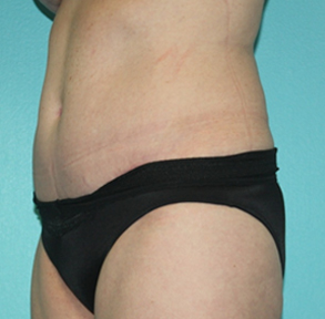 tummy-tuck-2-2a After