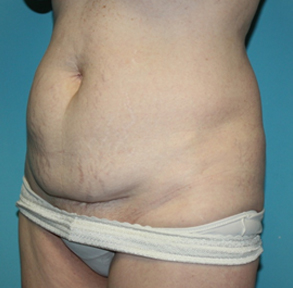 tummy-tuck-2-2b Before