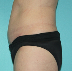 tummy-tuck-2-3a After