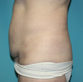 tummy-tuck-2-3b Before