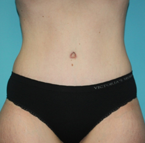 tummy-tuck-3-1a After