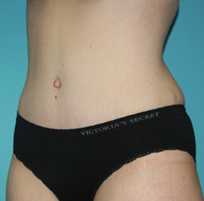 tummy-tuck-3-2a After