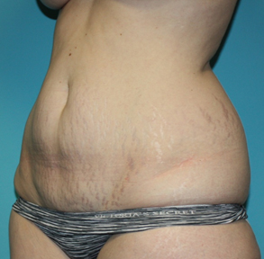 tummy-tuck-3-2b Before