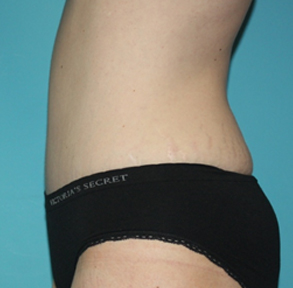 tummy-tuck-3-3a After