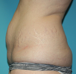 tummy-tuck-3-3b Before