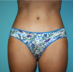 tummy-tuck-4-1a After