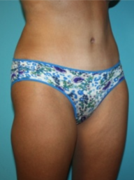 tummy-tuck-4-2a After