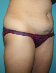 tummy-tuck-4-2b Before