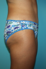 tummy-tuck-4-3a After
