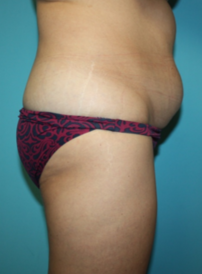 tummy-tuck-4-3b Before