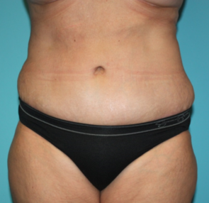 tummy-tuck-6-1a After